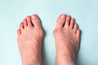 Choisir une orthèse ou attelle contre l’hallux valgus